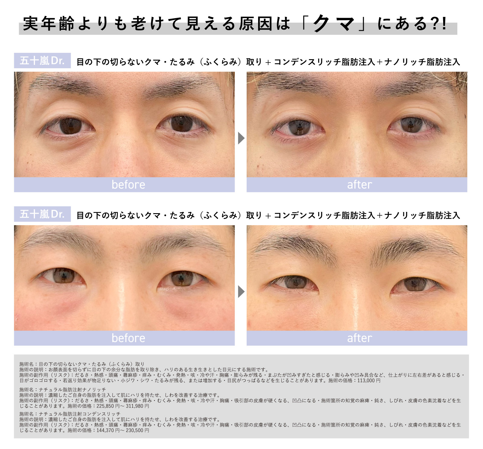 クマ取りは男性にもおすすめ！