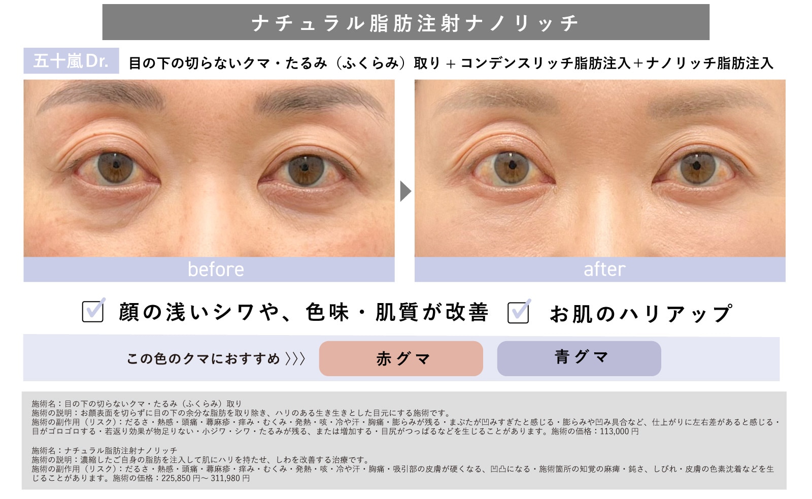 ナチュラル脂肪注射「ナノリッチ」