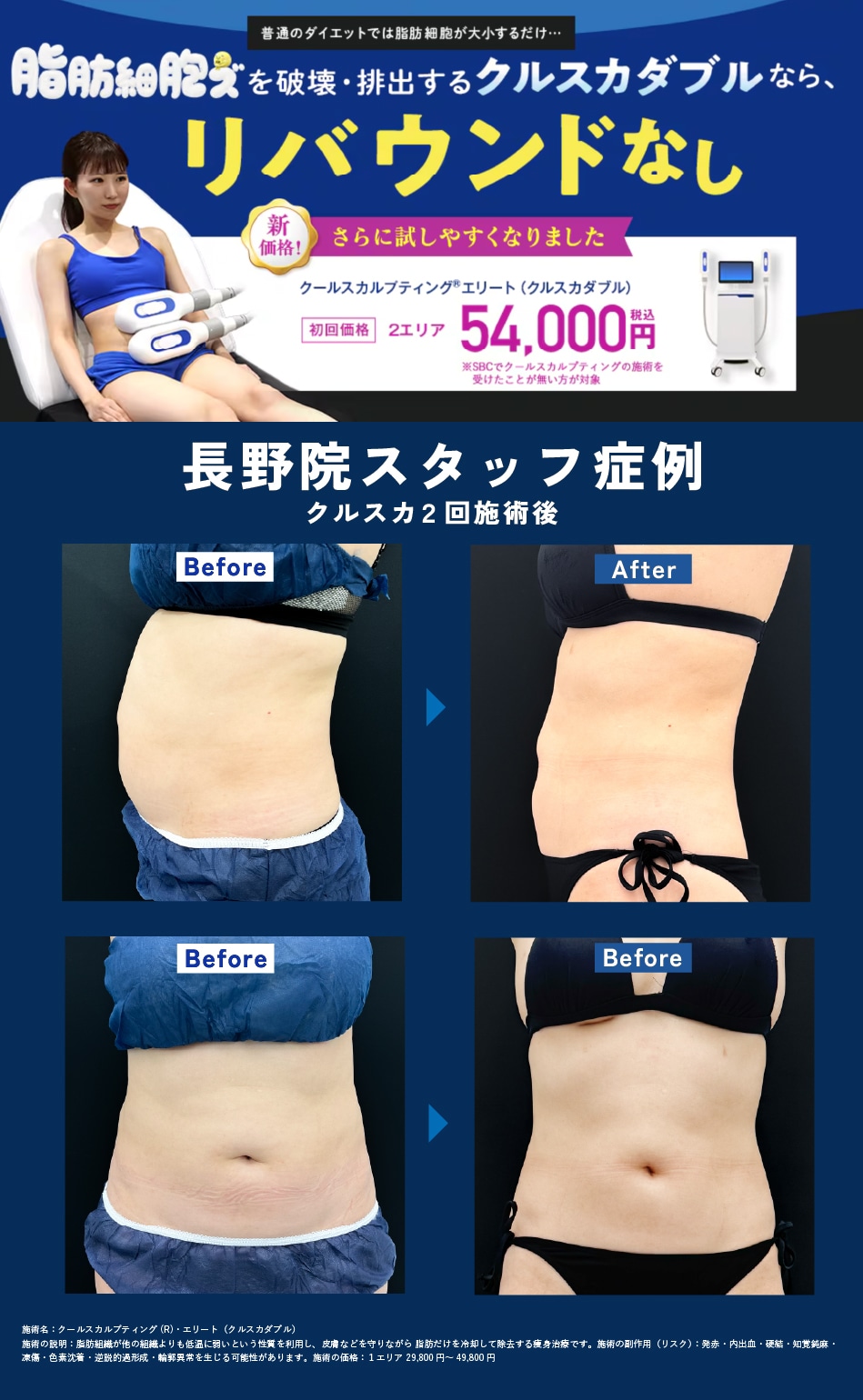 クールスカルプティング