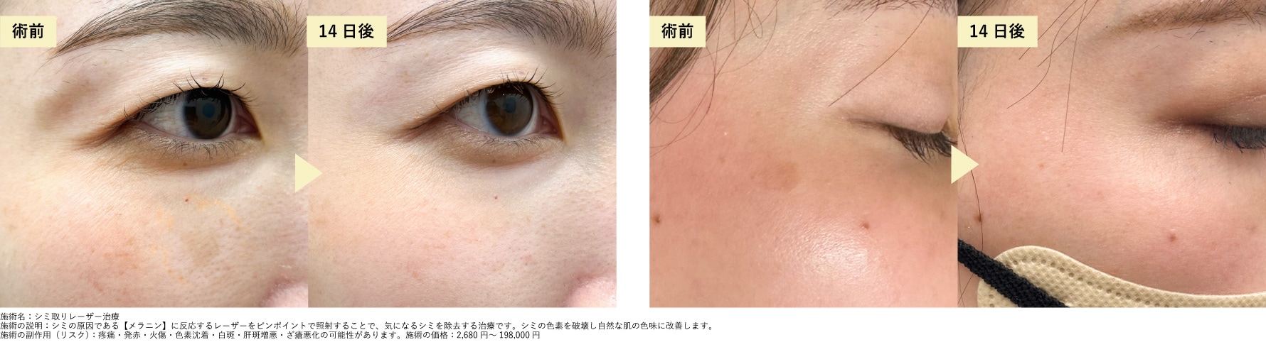 大きめのシミも綺麗に改善！