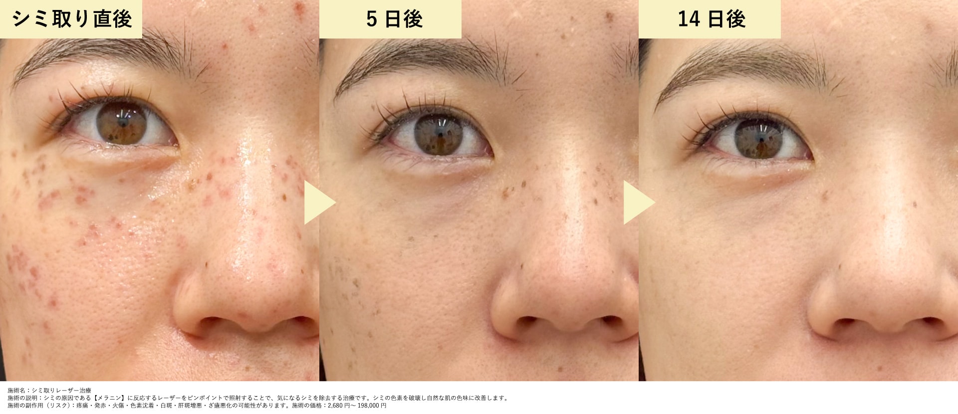 長野院スタッフのシミ取りダウンタイム