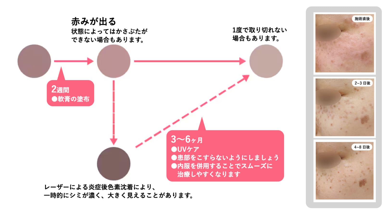 ダウンタイムの経過