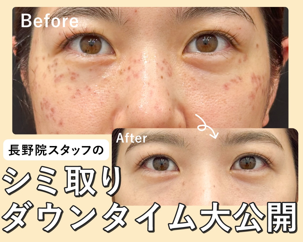 【長野県でシミ取り・シミ治療】スタッフのシミ取りダウンタイム大公開!