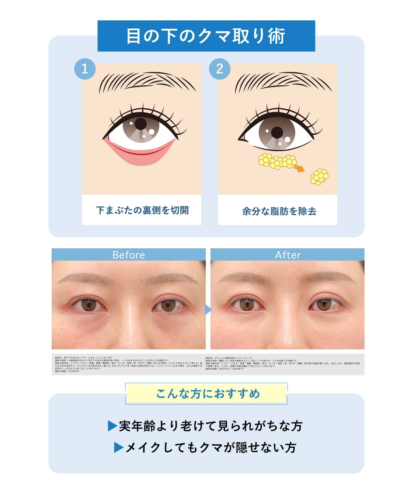 クマ取り術1. 目の下の切らないクマ取り・たるみ（ふくらみ）取り