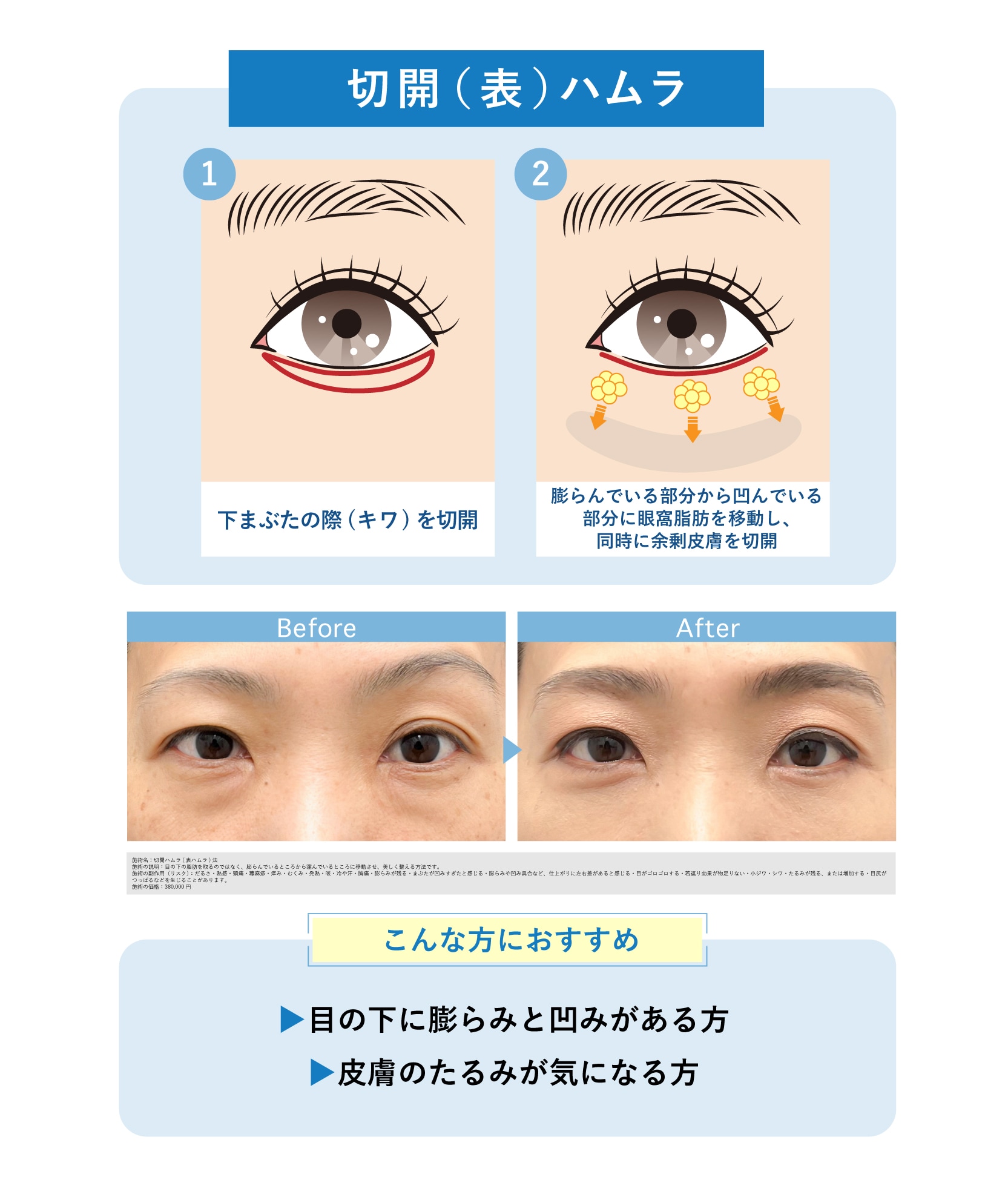 クマ取り術3.  切開（表）ハムラ