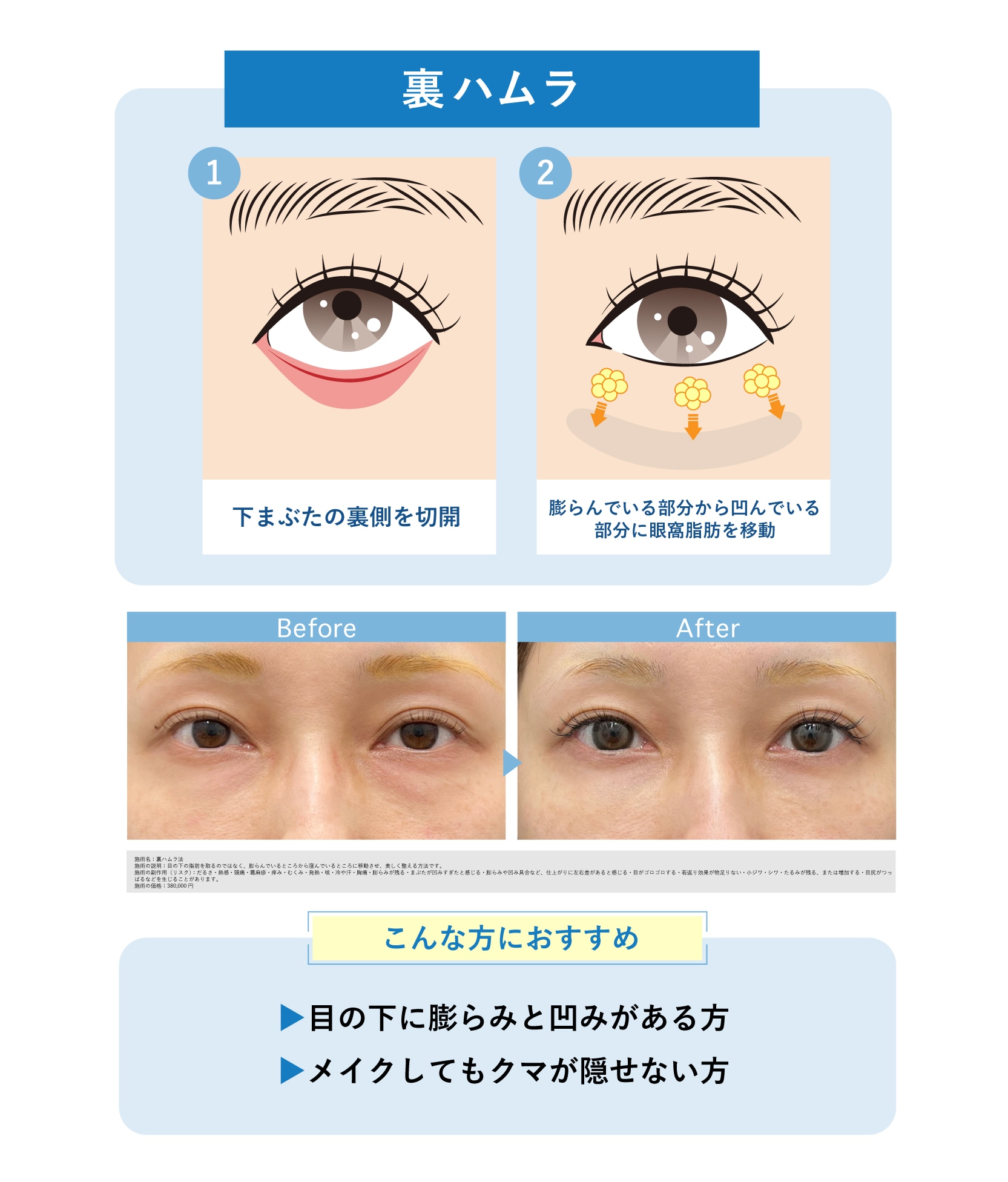 クマ取り術2. 裏ハムラ