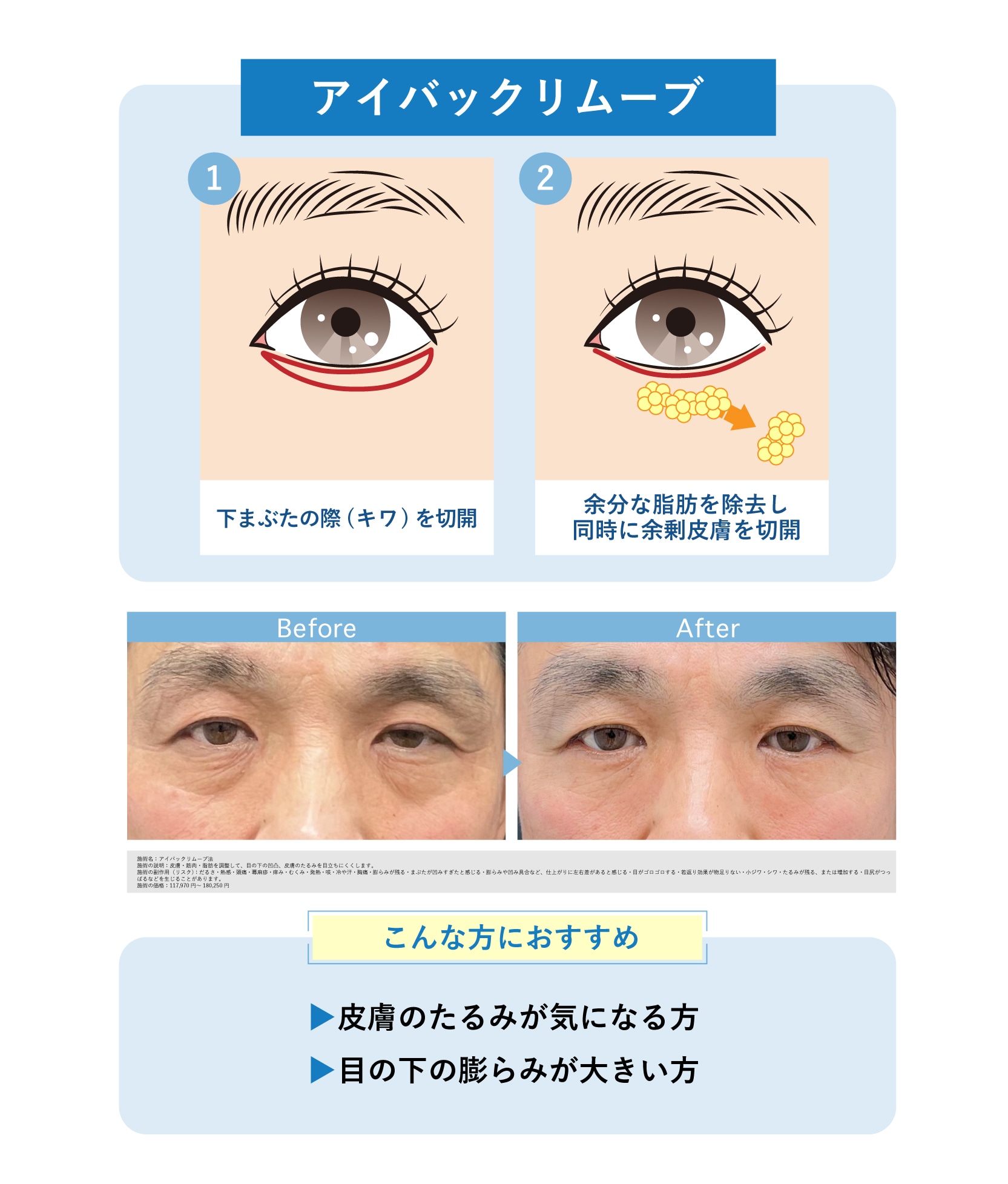 クマ取り術４.  アイバックリムーブ