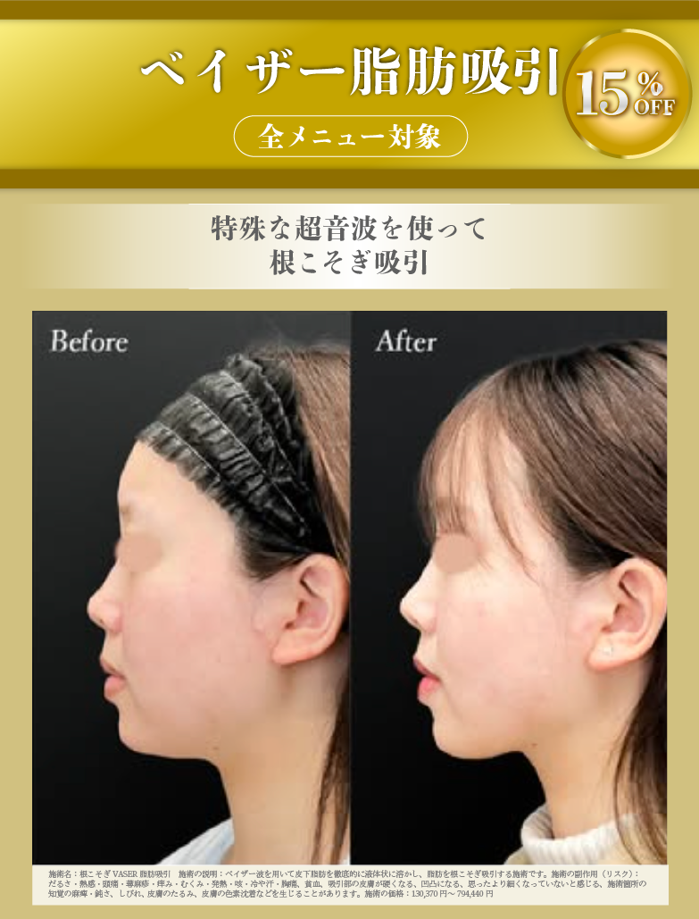 ベイザー脂肪吸引