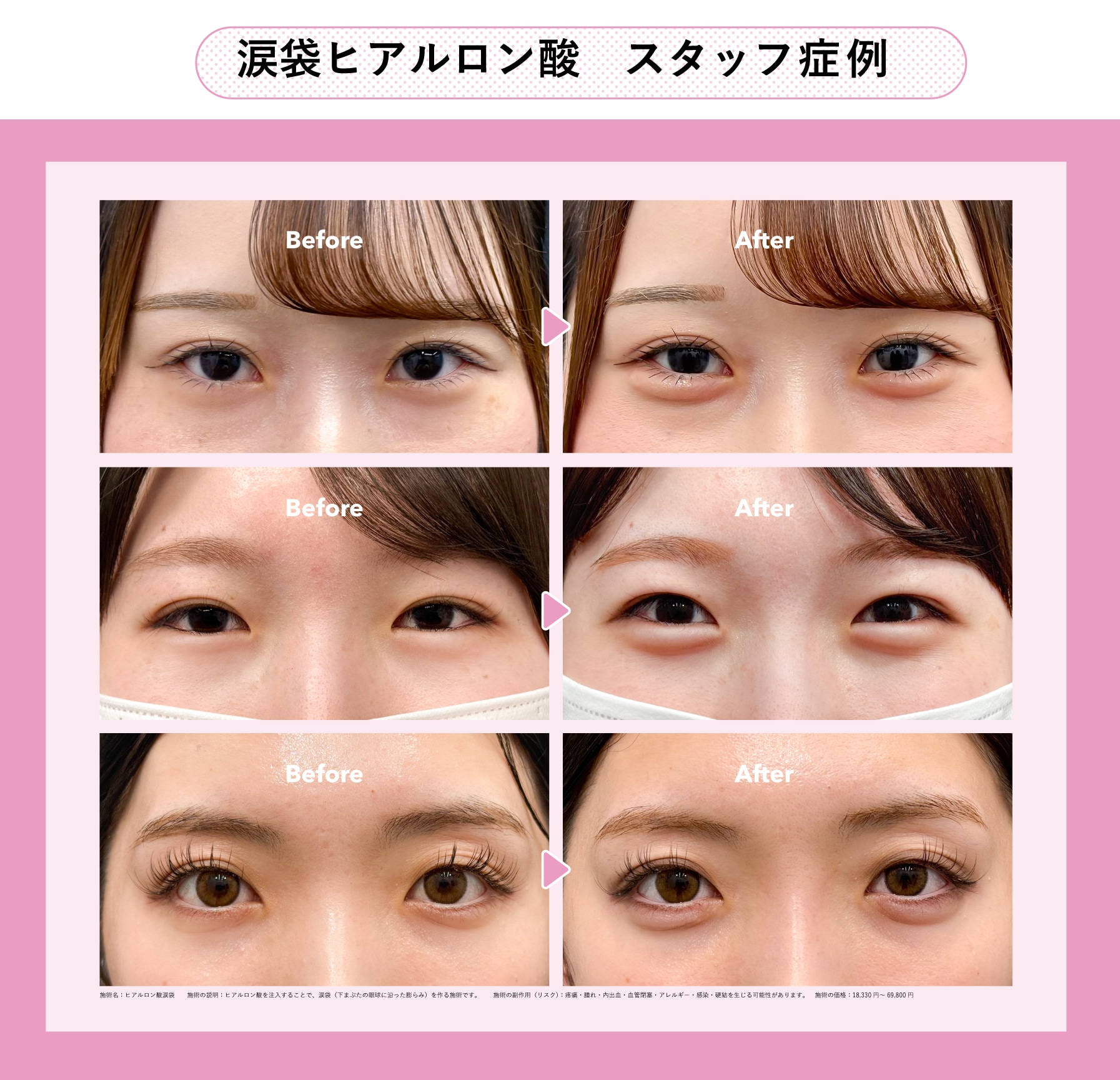 涙袋を作るなら、「涙袋ヒアルロン酸」