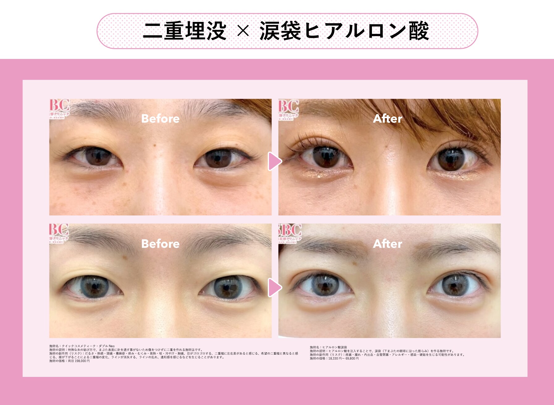 二重埋没×涙袋ヒアルロン酸