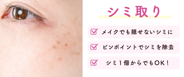 シミ取りレーザー