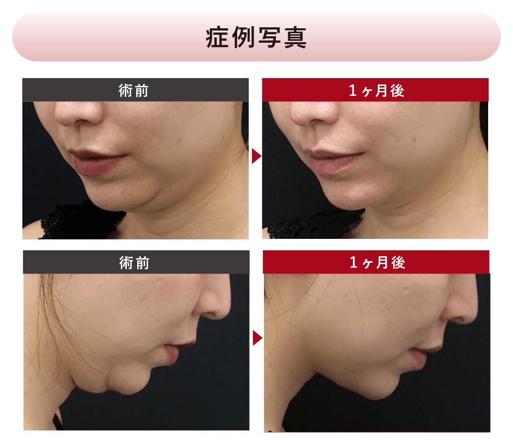 顎下の悩みが劇的改善！