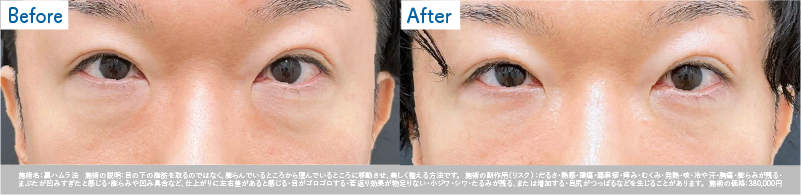 【40代 男性】 裏ハムラ症例