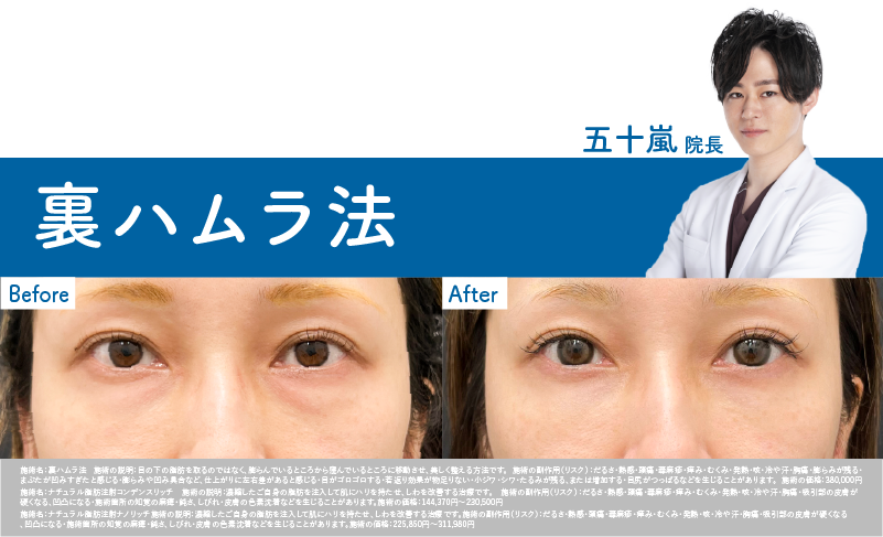 【30代 女性】 裏ハムラ症例