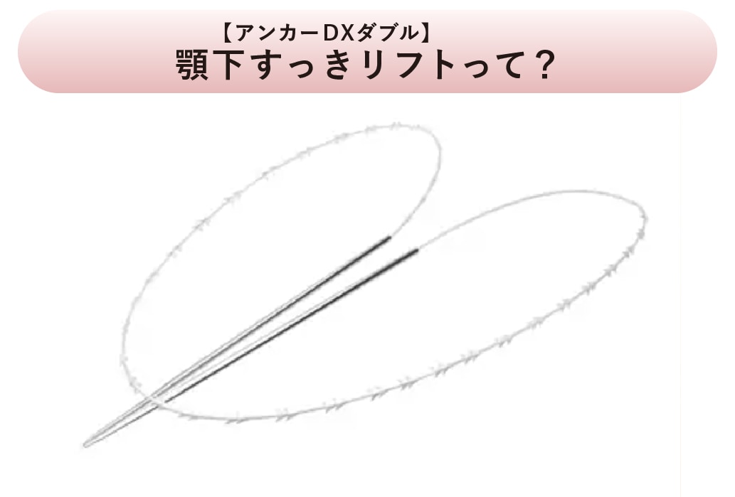 顎下専用に開発された糸リフト