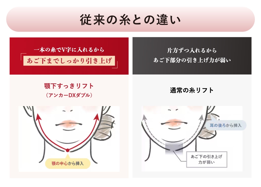 従来の糸リフトとの違い