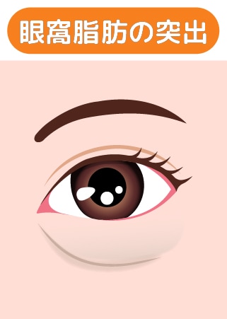 眼窩脂肪の突出