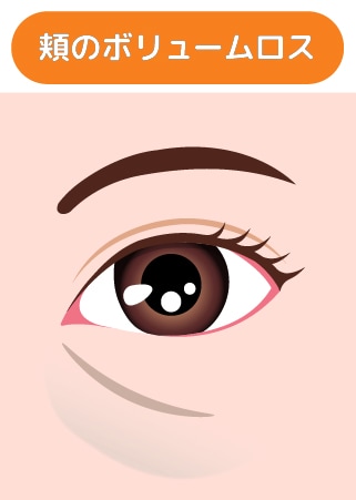 頬のボリュームロス