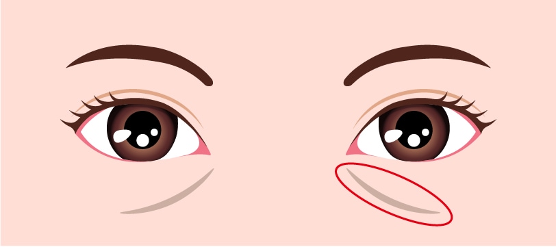 脱脂だけでは改善しなかった悩みを解決◎