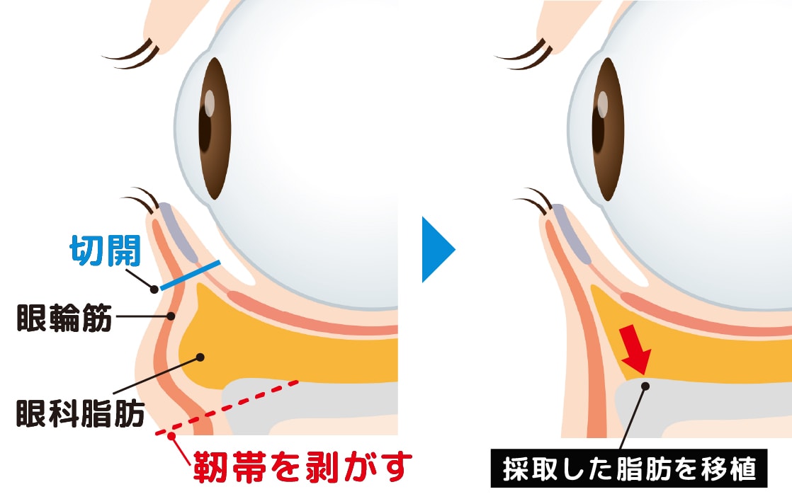 ミニ裏ハムラの施術方法