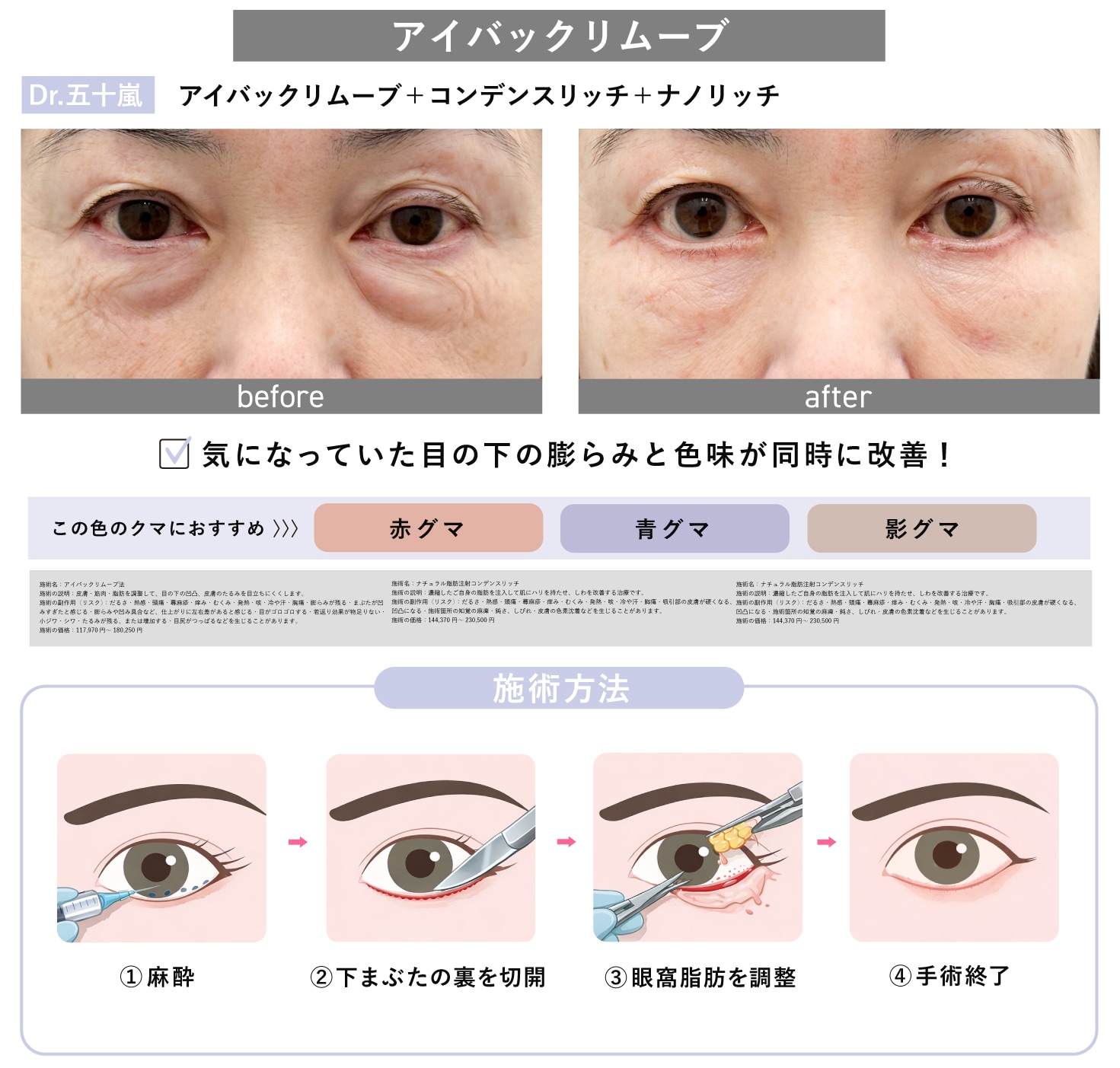 アイバックリムーブ