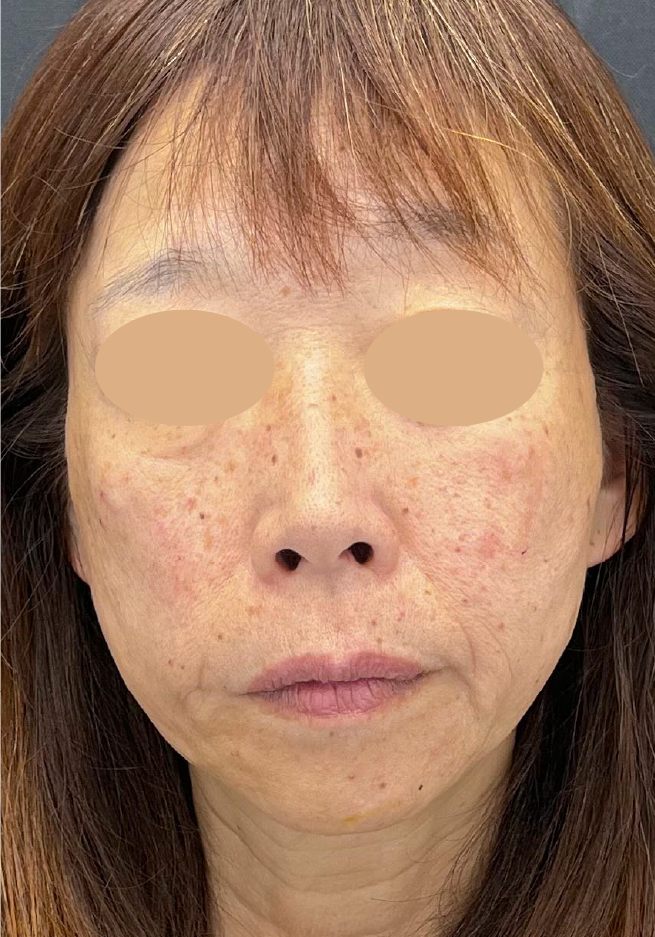 {施術名} {年代}  {性別} の術後の症例写真