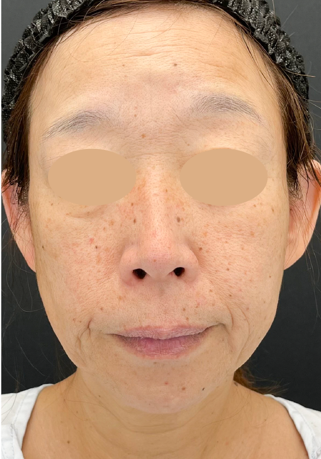 {施術名} {年代}  {性別} の術前の症例写真