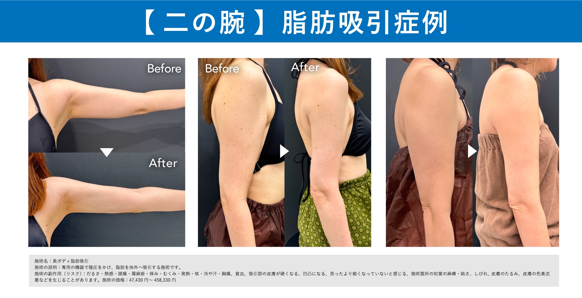 【症例02】二の腕