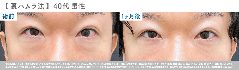 【40代 男性】 裏ハムラ症例