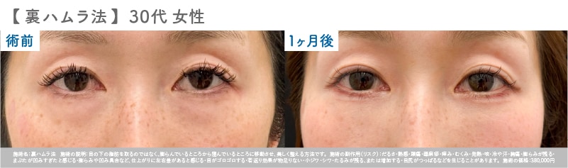 【30代 男性】 裏ハムラ症例