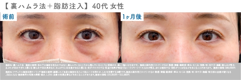 【40代 女性】 裏ハムラ＋脂肪注入症例