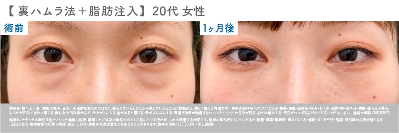 【20代 女性】 裏ハムラ症例