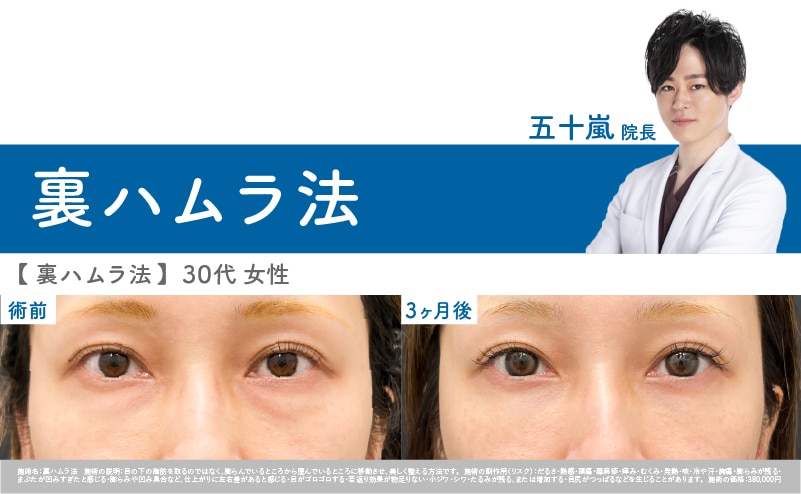 【30代 女性】 裏ハムラ症例