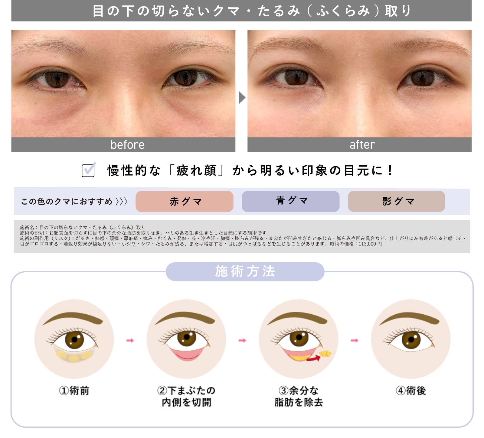 目の下の切らないクマ・たるみ（ふくらみ）取り