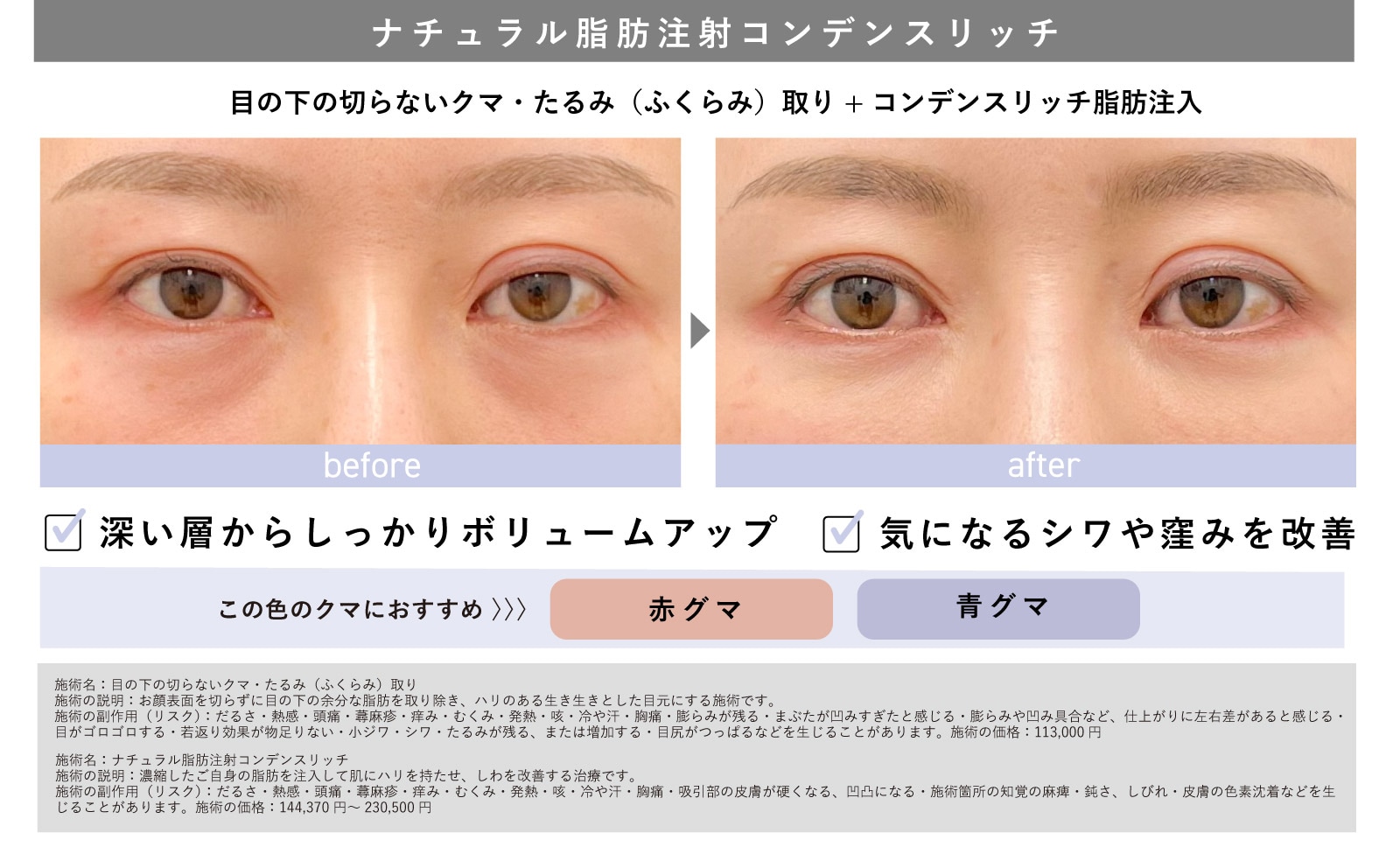 ナチュラル脂肪注射「コンデンスリッチ」