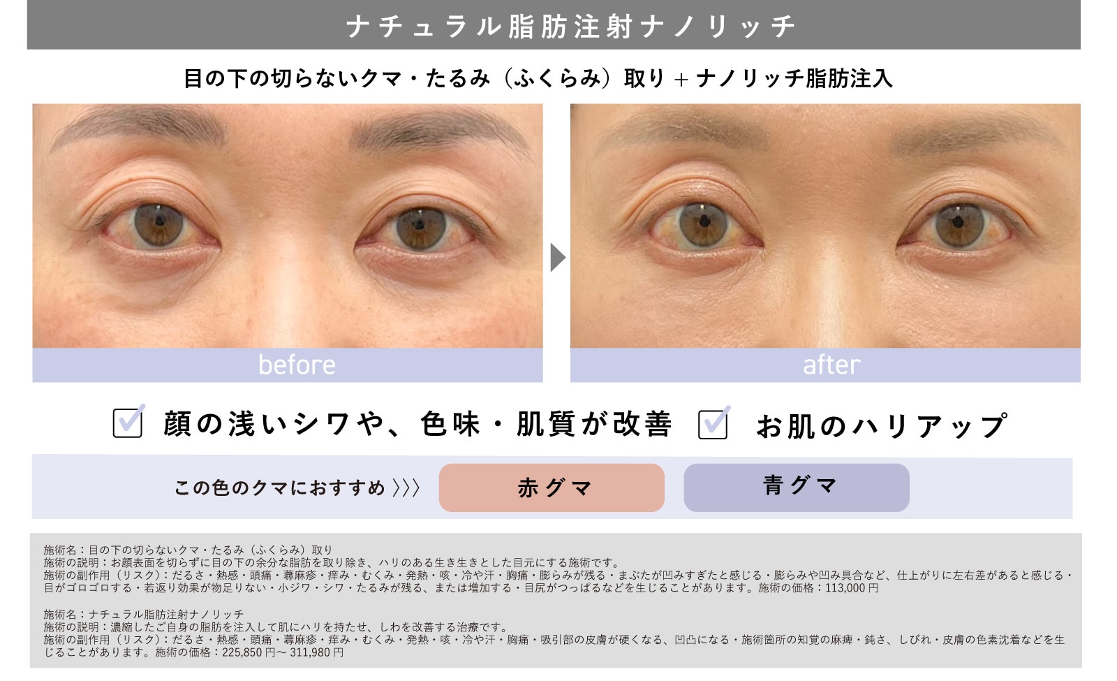 ナチュラル脂肪注射「ナノリッチ」