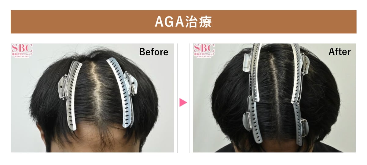 おでこのM字はAGA治療で早急に対処！