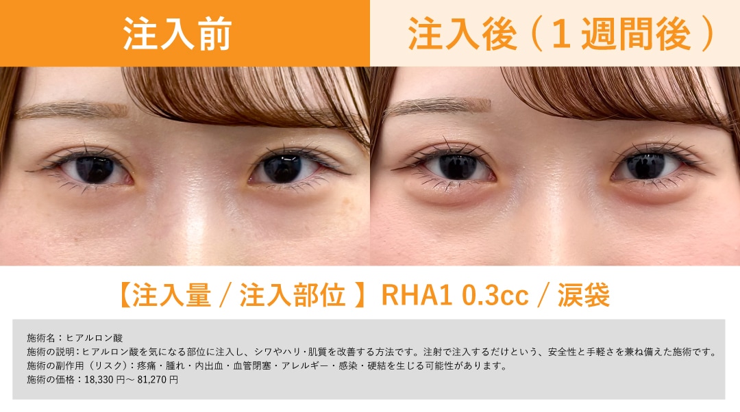 涙袋