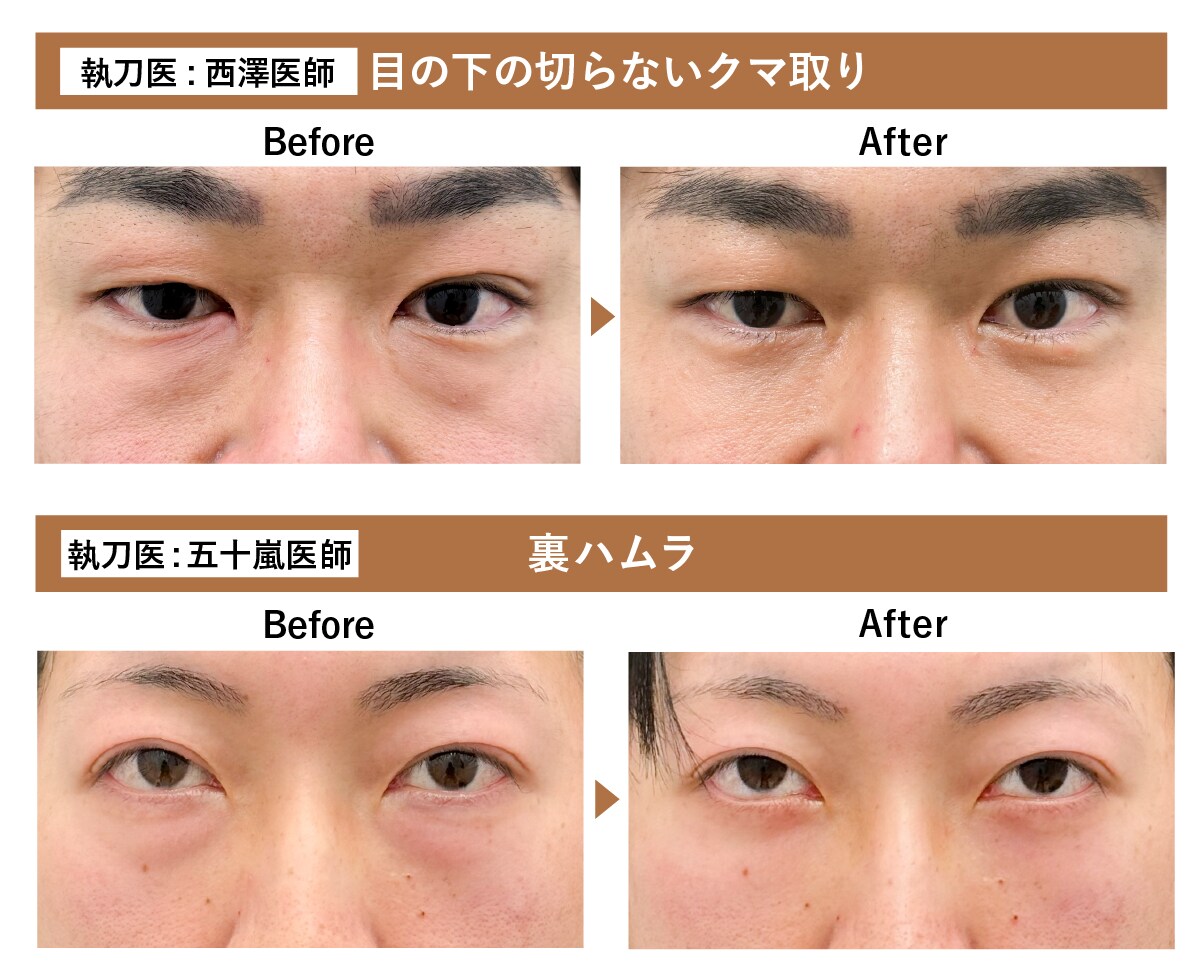 目の下の老けには「クマ取り」