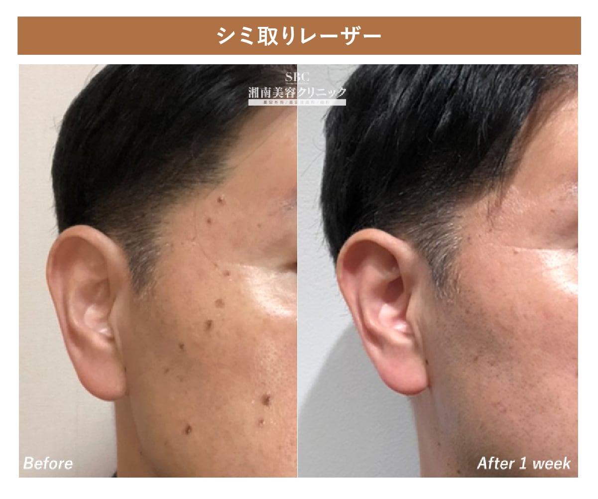 シミ取りレーザー