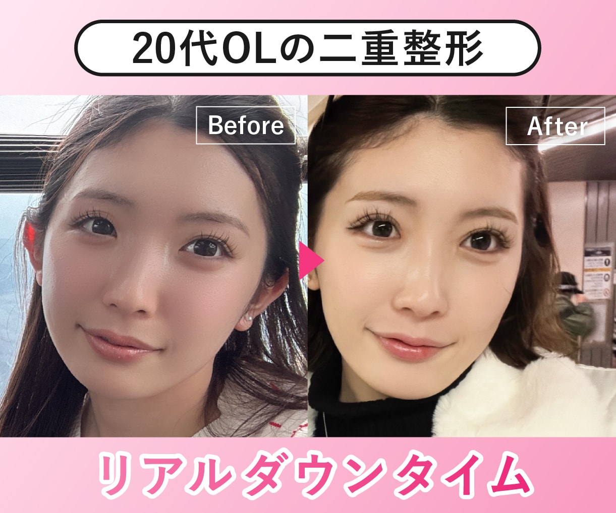 【公開】二重埋没後のダウンタイムに密着！🎶