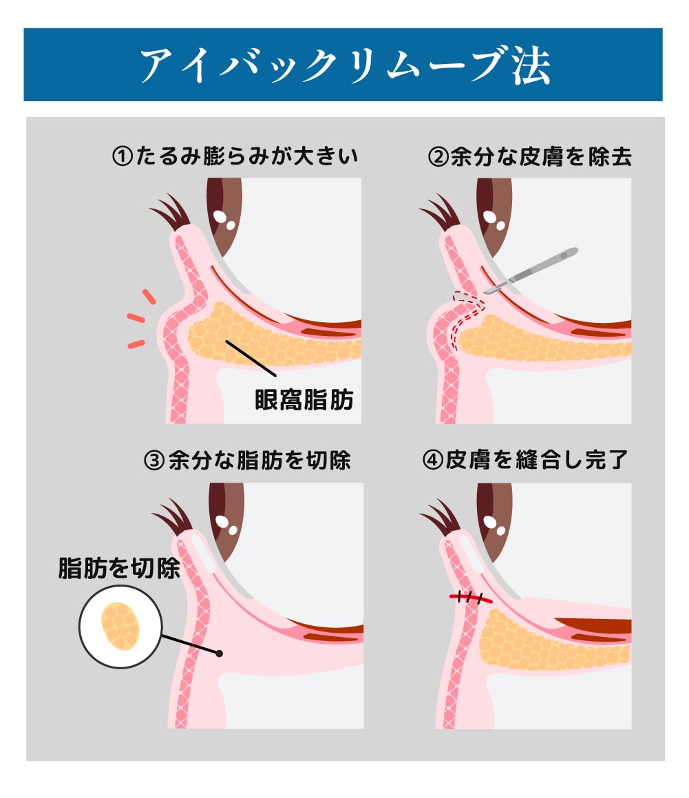 アイバックリムーブ法とは？