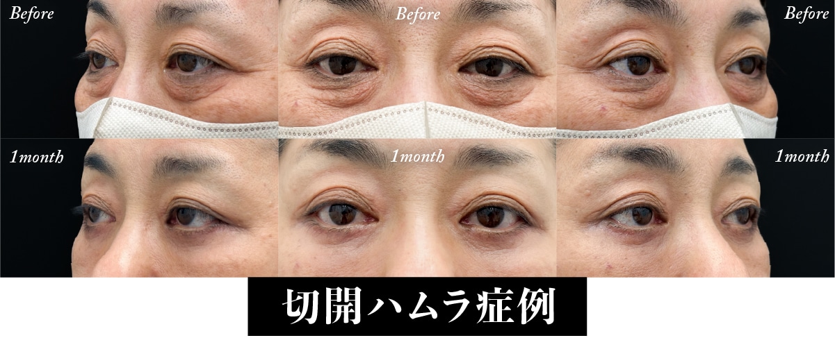 余った皮膚を切ることで、より仕上がりが綺麗に✨
