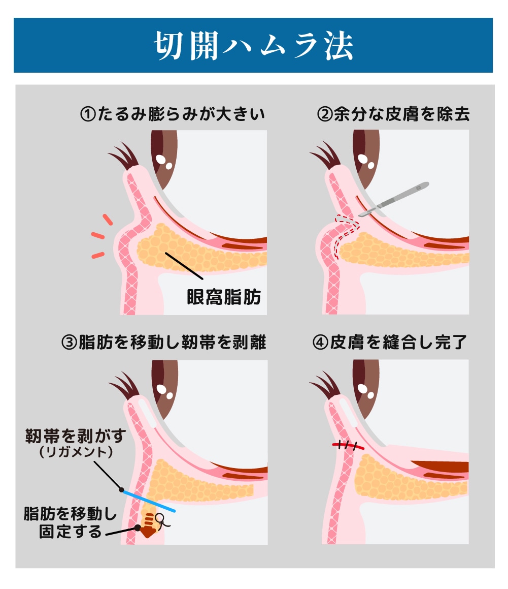 切開ハムラ法とは？