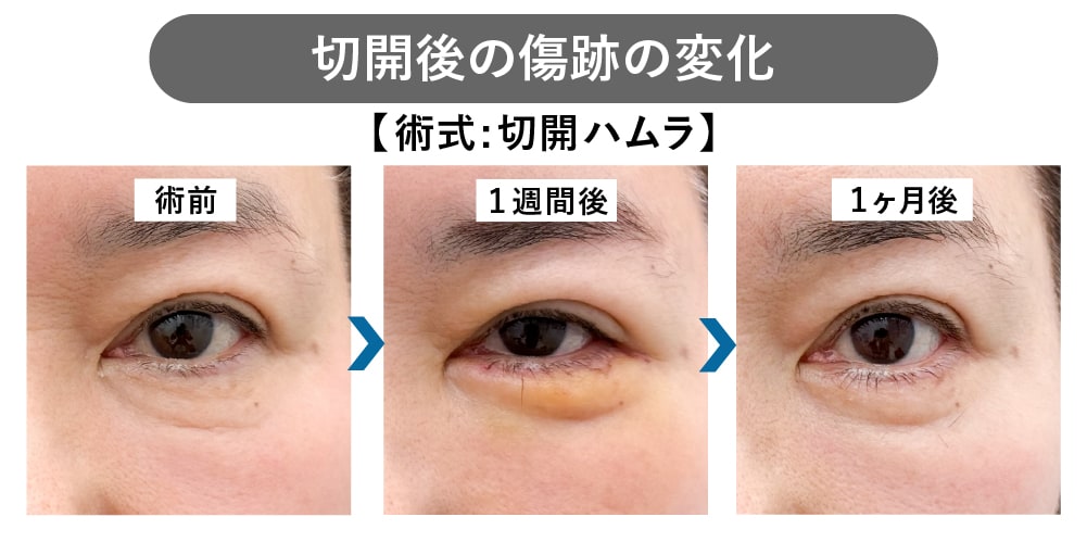 切開の傷跡