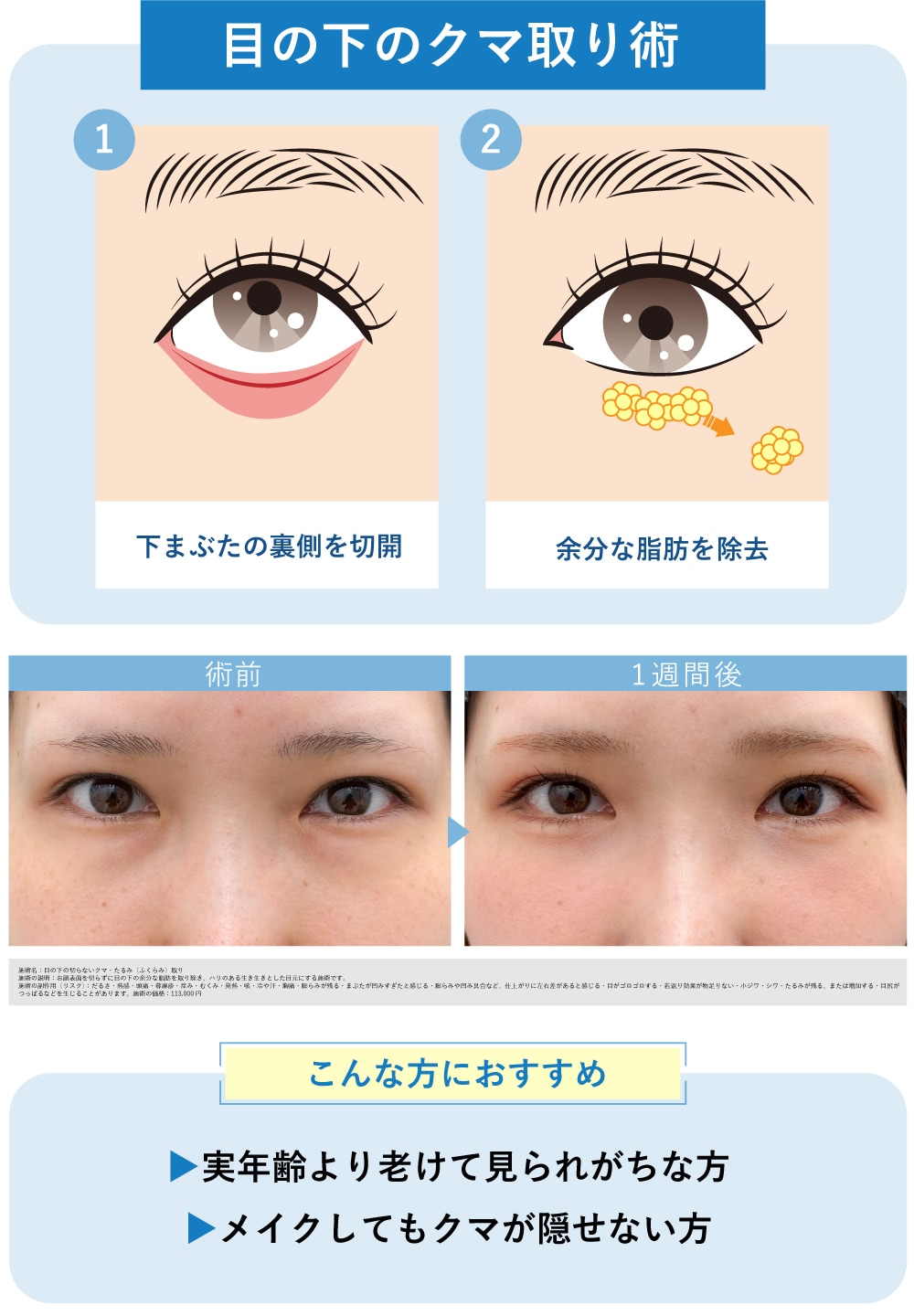 クマ取り術1　〉〉〉 目の下の切らないクマ取り・たるみ（ふくらみ）取り