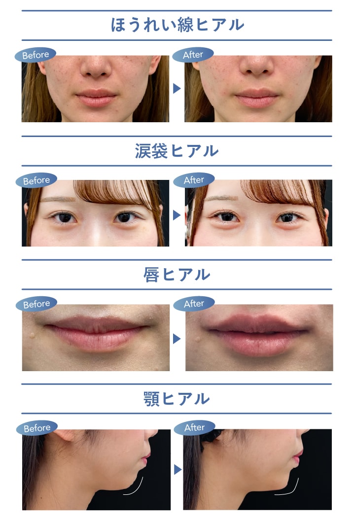人気のヒアルロン酸症例
