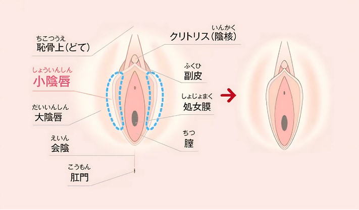 小陰唇縮小術