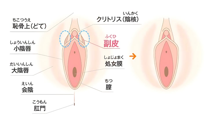 副皮除去術