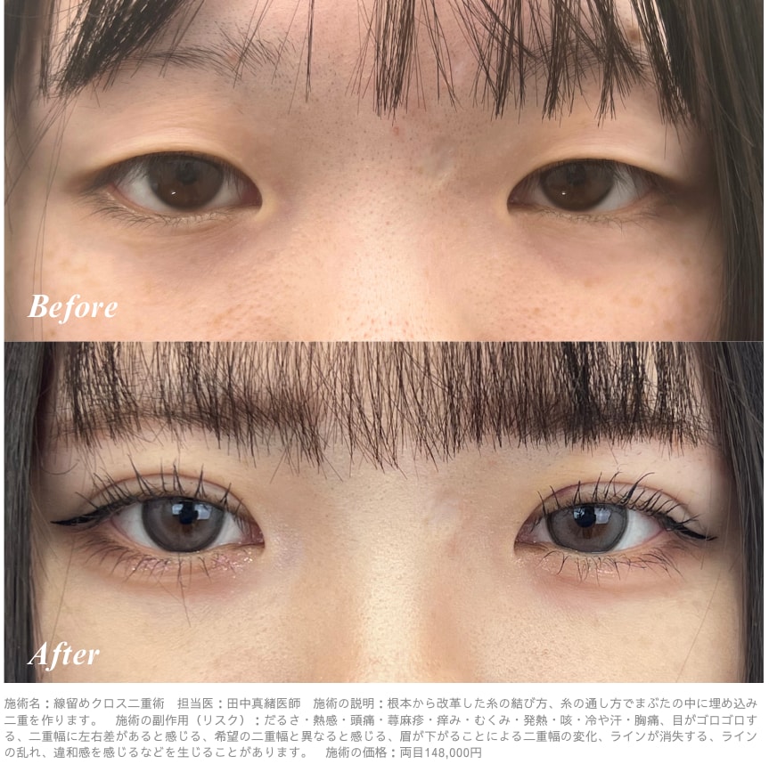 フォーエバー二重術